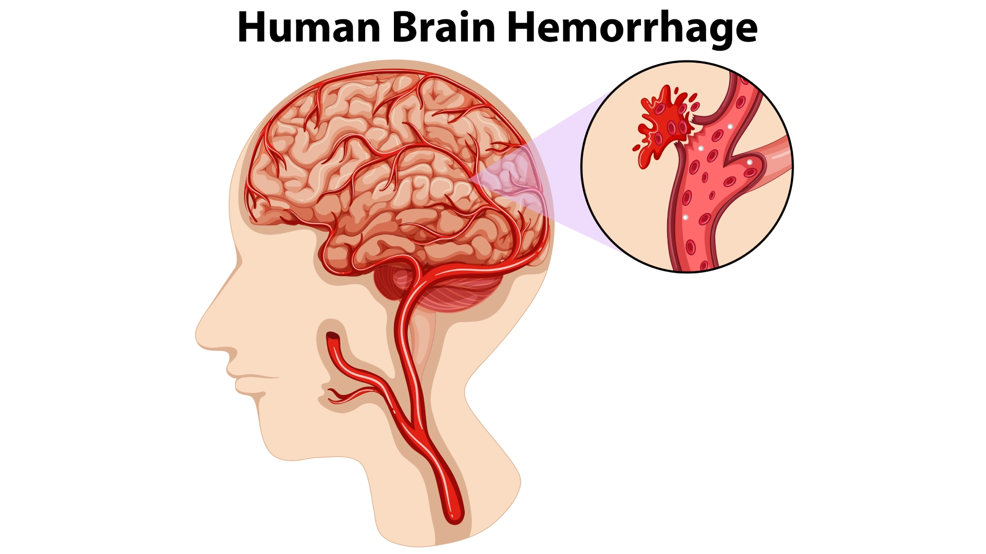 Brain Haemorrhage: A Complete, Actionable Guide