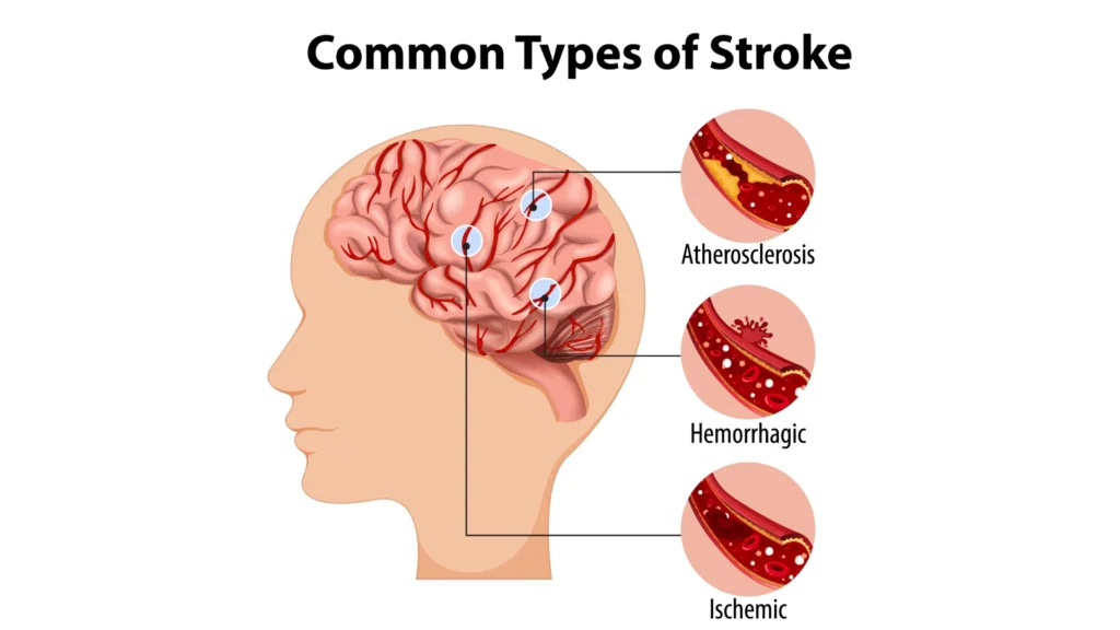 Brain Stroke: When Every Minute Decides the Future
