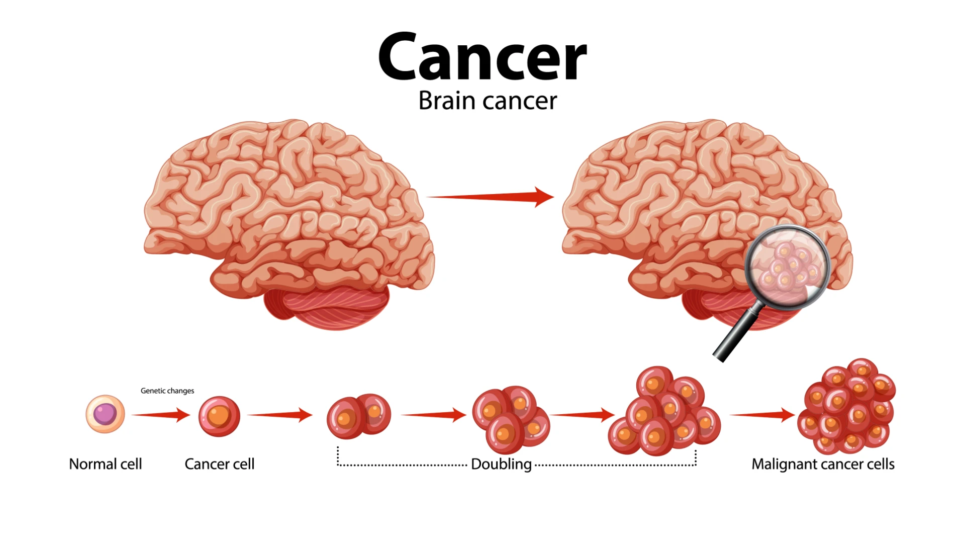 Brain Tumours: Understanding the Growth That Disrupts the Brain’s Balance