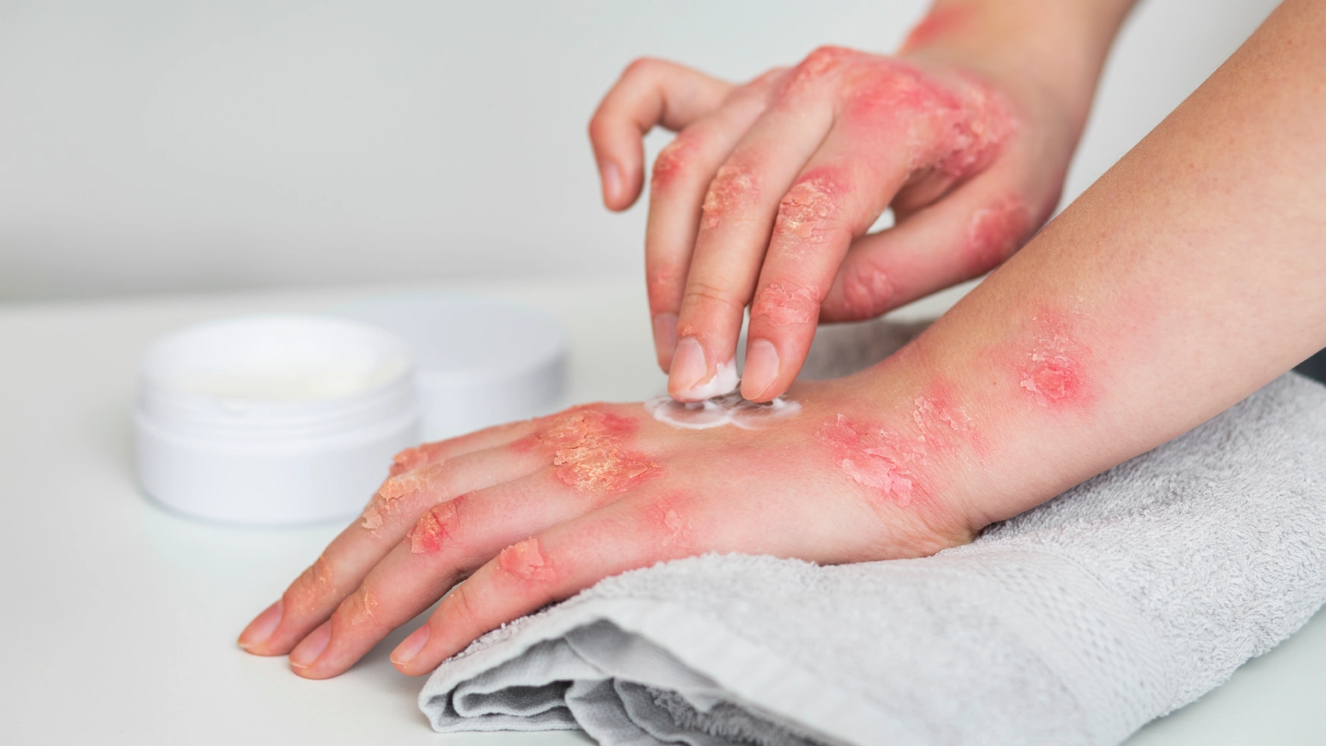 Hematoma: What It Is, Why It Happens, and How It’s Treated