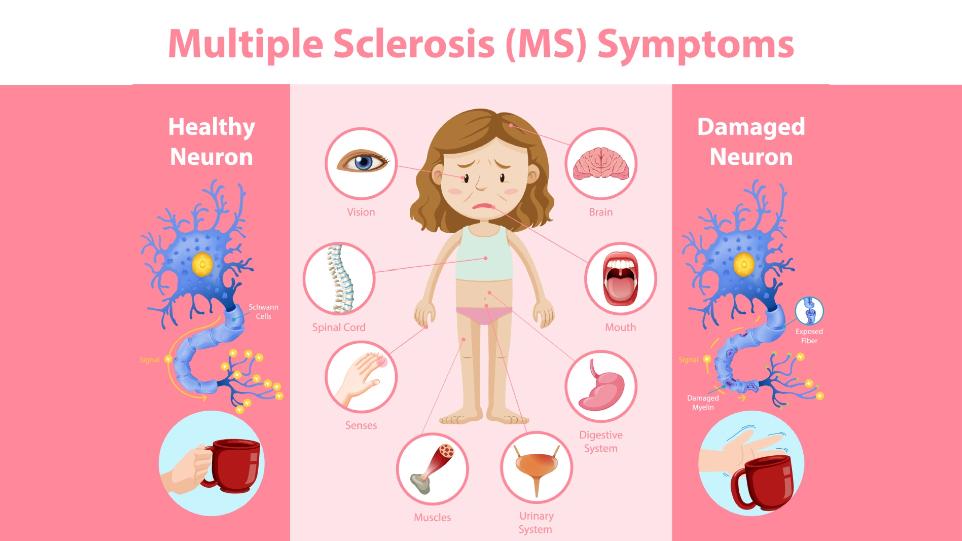 Multiple Sclerosis: A Degenerative Neurological Condition
