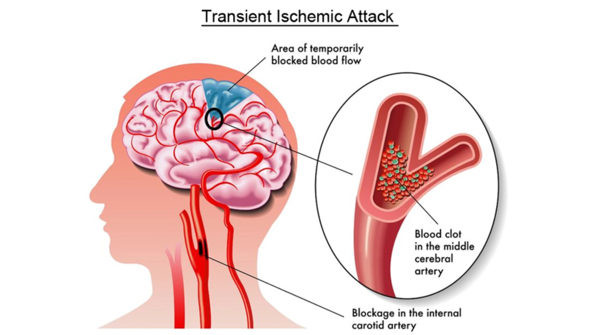 Post Stroke Conditions Cause Long-term Effects