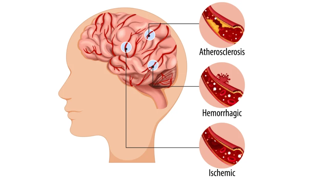 Types of Brain Stroke: Understanding What Happens Inside the Brain