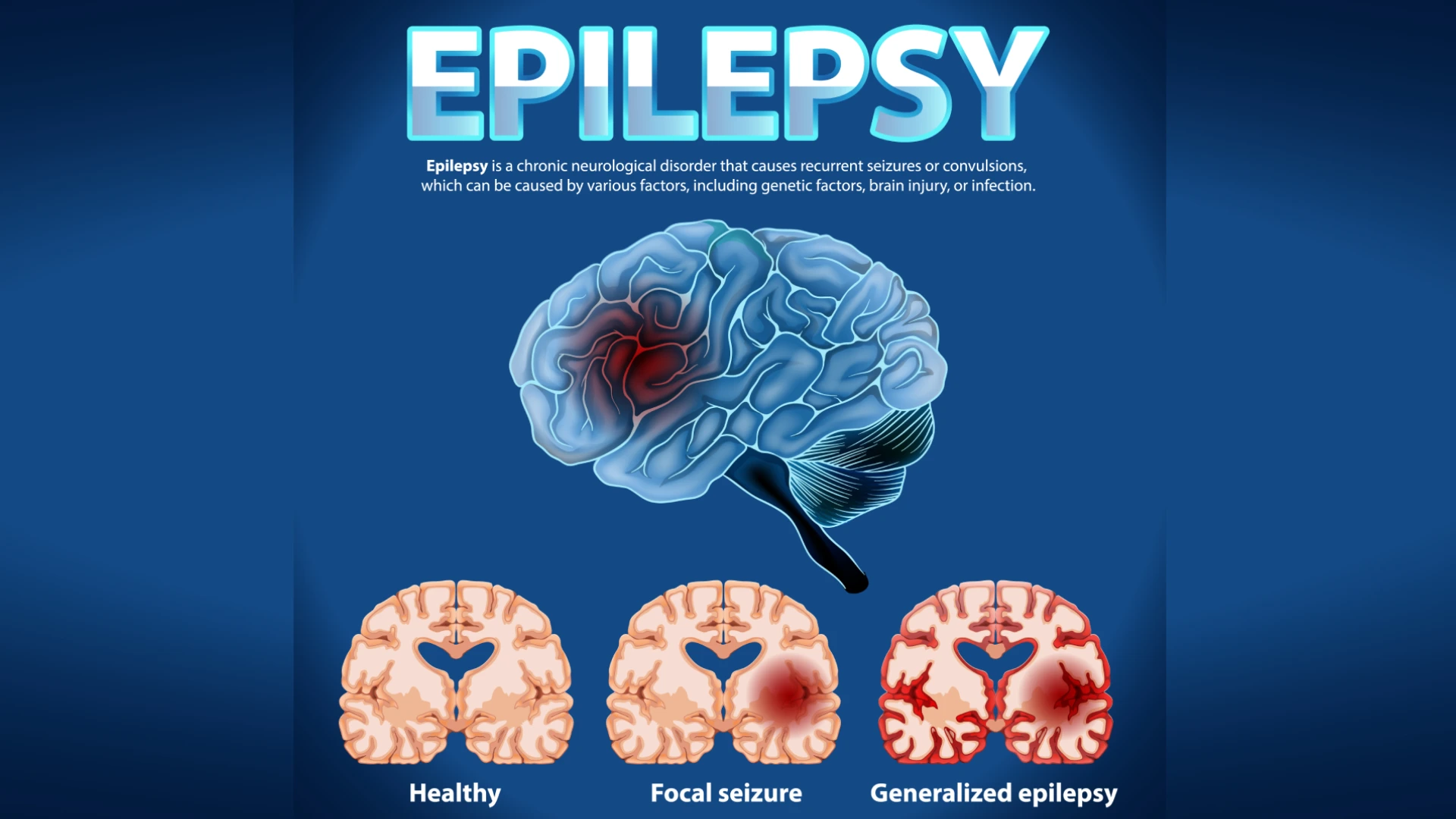 Types of Epilepsy: Understanding the Many Faces of a Single Condition