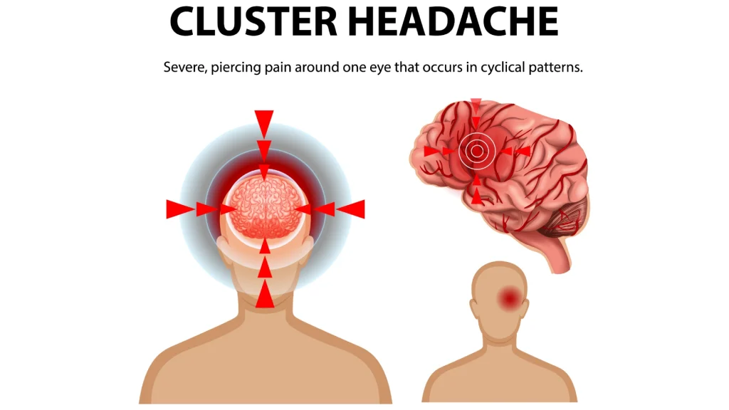 Cluster Headaches