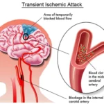 warning-signs-of-stroke
