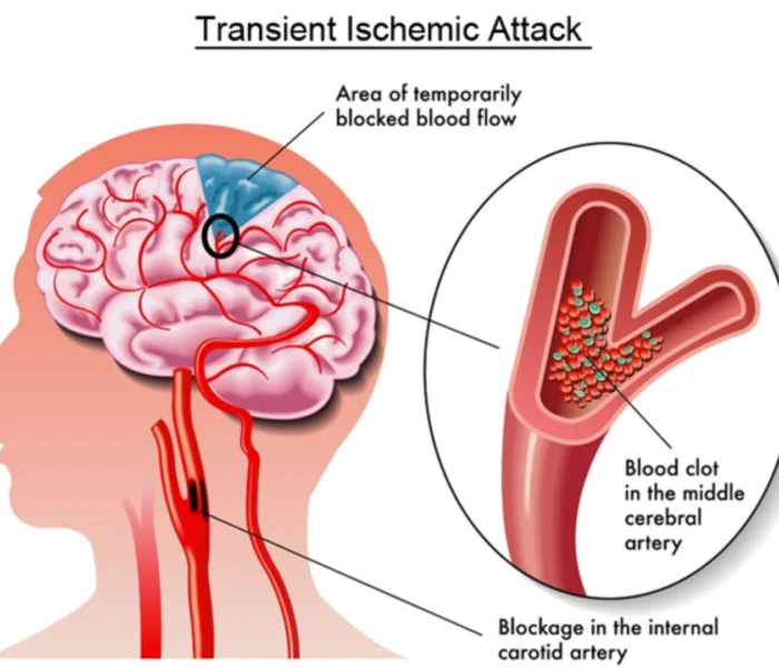 warning-signs-of-stroke