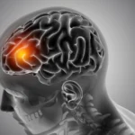 early-signs-of-brain-tumour